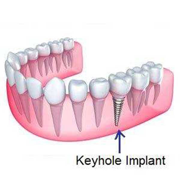 Single tooth implant